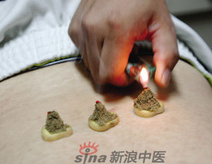 灸法的種類  你知道多少？